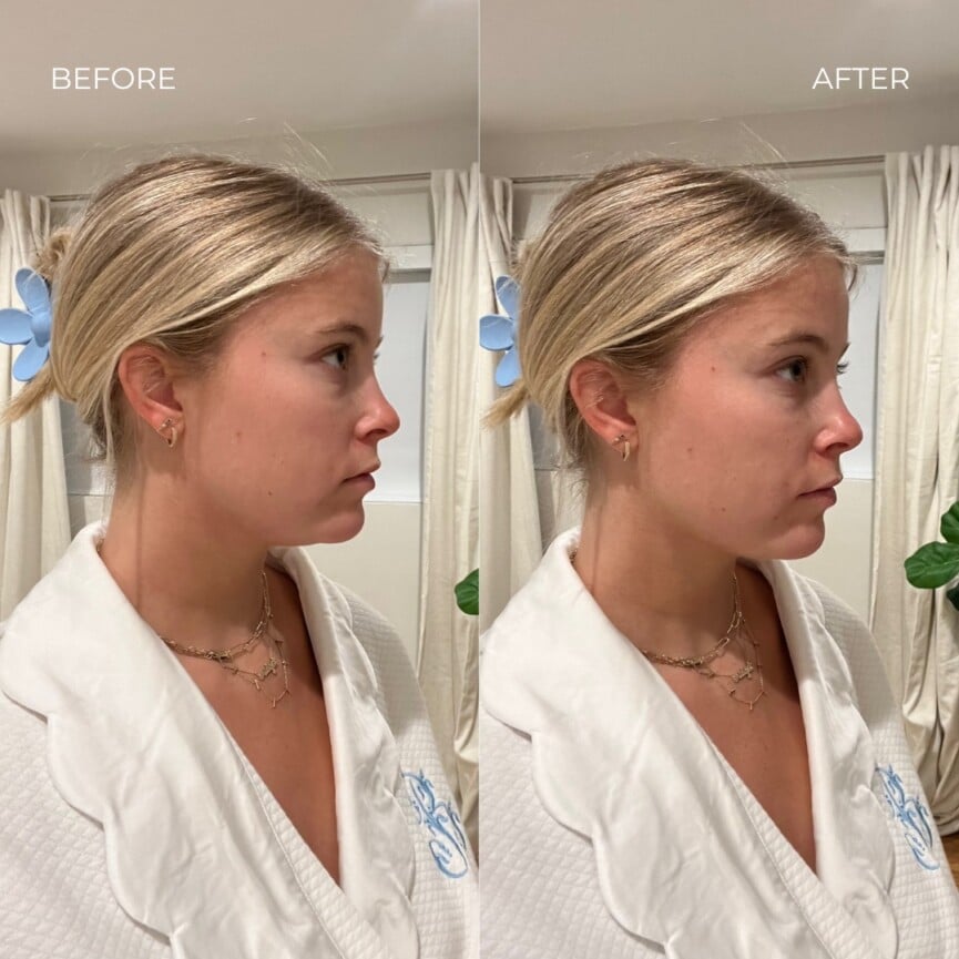 Solesse Face Slimming Strap™